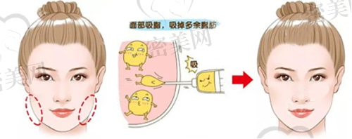 惠州鹏爱医疗美容：抗衰老项目优选