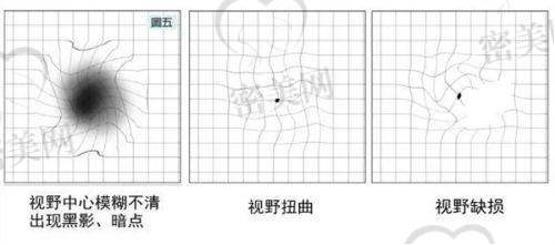 除了近视！乌鲁木齐普瑞眼科这些项目也受关注