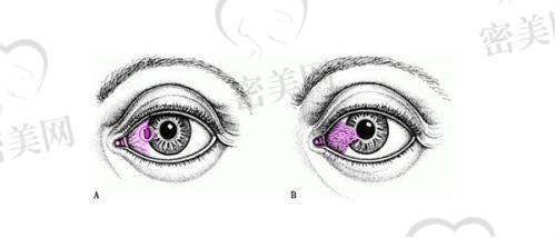 后巩膜加固术详解：适合谁？真的有效吗？