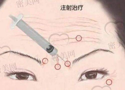 玻尿酸除皱能维持多久？