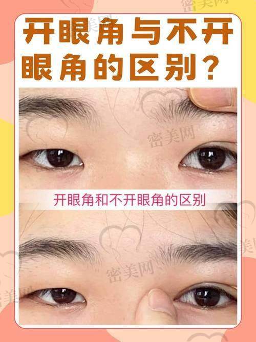 王衡健医生开内眼角做开扇手术案例多吗?手术效果、恢复时间及口碑情况揭秘 