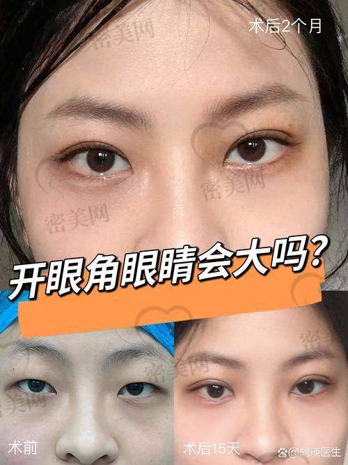 王衡健医生开内眼角做开扇手术成效如何？眼见为实