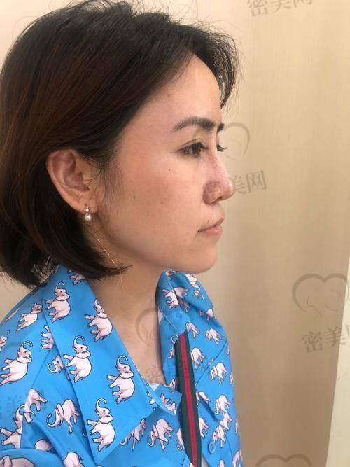 二次鼻修复手术：紧张又期待