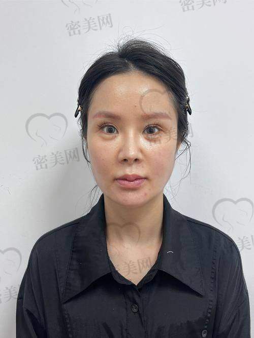 四、鼻子打玻尿酸哪些牌子好