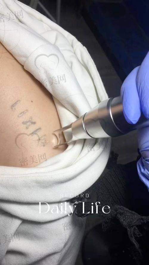 重庆军科疤痕中 心党永明仪器洗纹身的“口碑传奇”