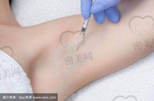 淄博希美医疗美容诊所：适合轻中度腋臭人群