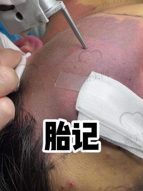 党永明医生祛胎记优势大揭秘，5000元花得值