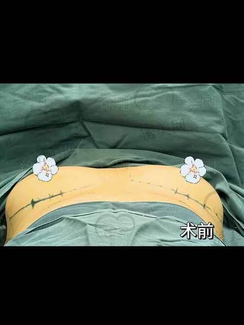 重庆军科整形范文亮假体隆胸：技术优势大揭秘！