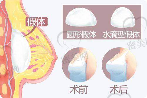 总结与建议：给想做罗盛康假体隆胸的姐妹们