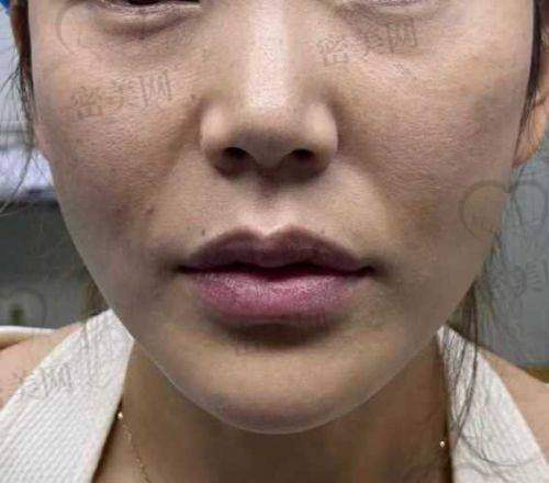五、打鼻子玻尿酸的医院选择