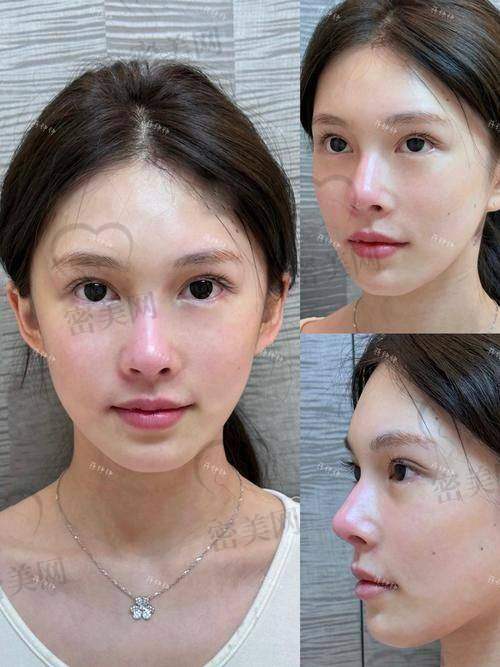 重庆松山整形医院段艳军鼻修复：技术优势大揭秘