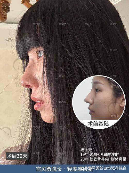 重庆松山整形医院段艳军：46800 起的鼻修复价格有多香？