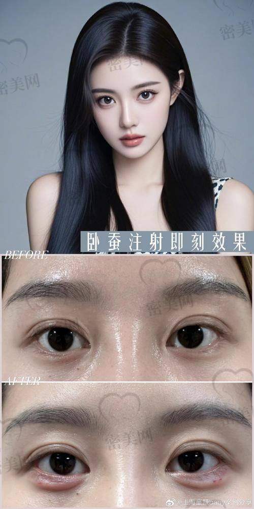 眼窝凹陷填充手术的风险