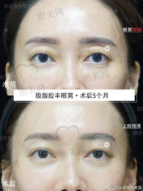 自体脂肪填充