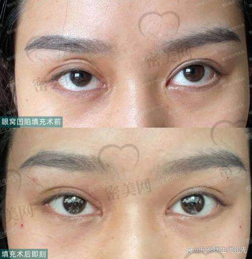 眼窝凹陷填充的常见方法及费用