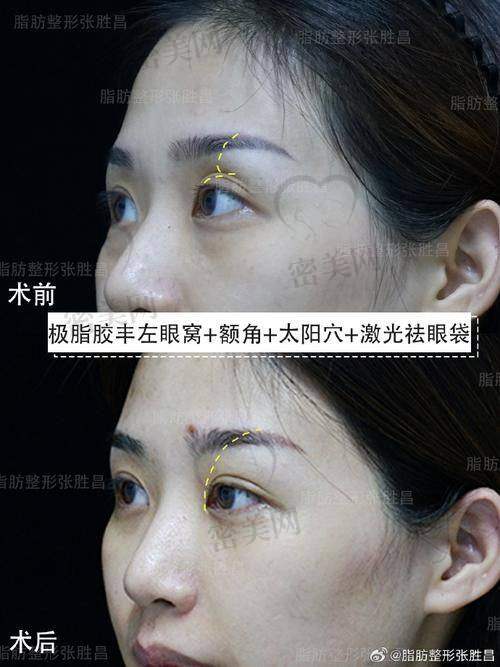 眼窝凹陷的原因