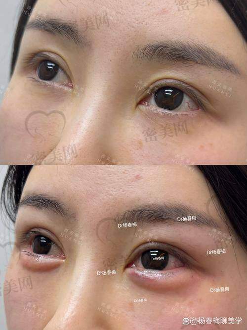 眼窝凹陷填充的未来发展趋势
