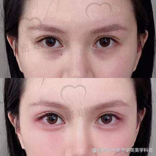 眼窝凹陷填充前后对比及持久填充材料
