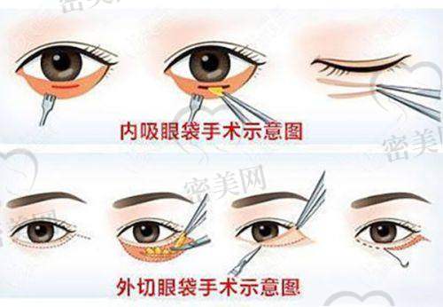 汉中华美奥莱双眼皮适合哪些人？