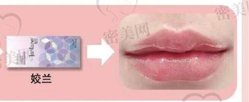 热门整形项目与做嘟嘟唇的搭配