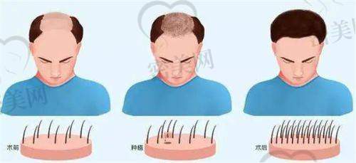 北京碧莲盛植发医院是正规的吗？