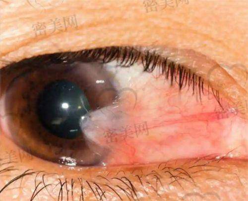 北京同仁眼科医生PK | 李婧的技术标签:视觉质量提升+ICL个性化设计达人