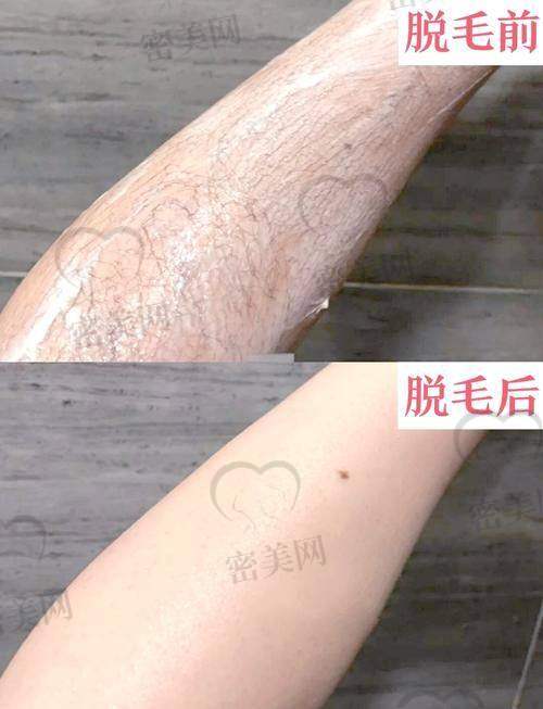 大连激光脱毛医院推荐一览表