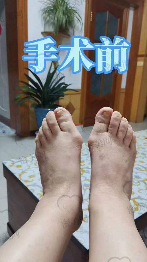 价格来了！苏敬达大脚骨手术怎么收费？