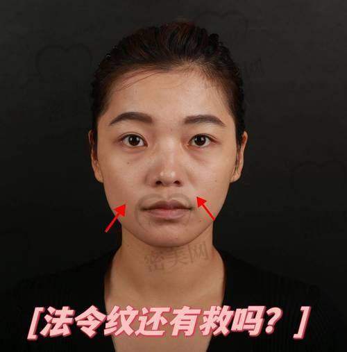 打法令纹针的副作用全解析
