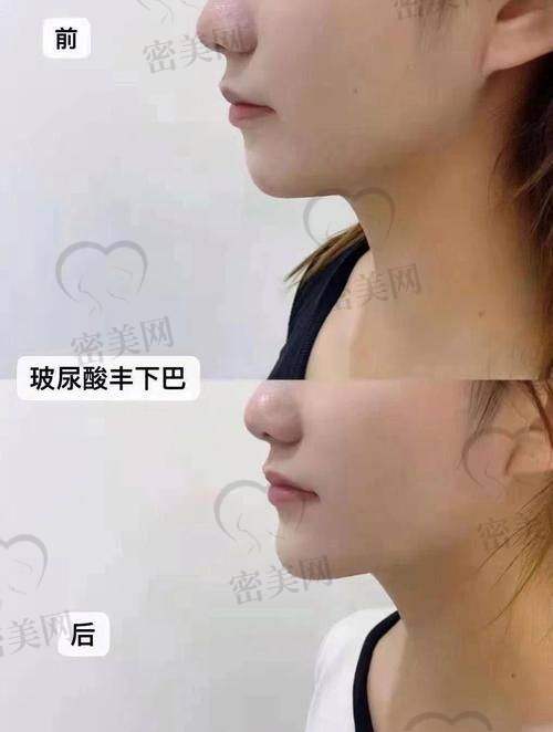 爱芙莱玻尿酸相关的真人实例分享