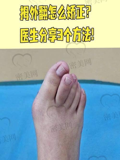 北京圣嘉新医院苏敬达医生简介：大脚骨矫正圈里的硬核骨干医生