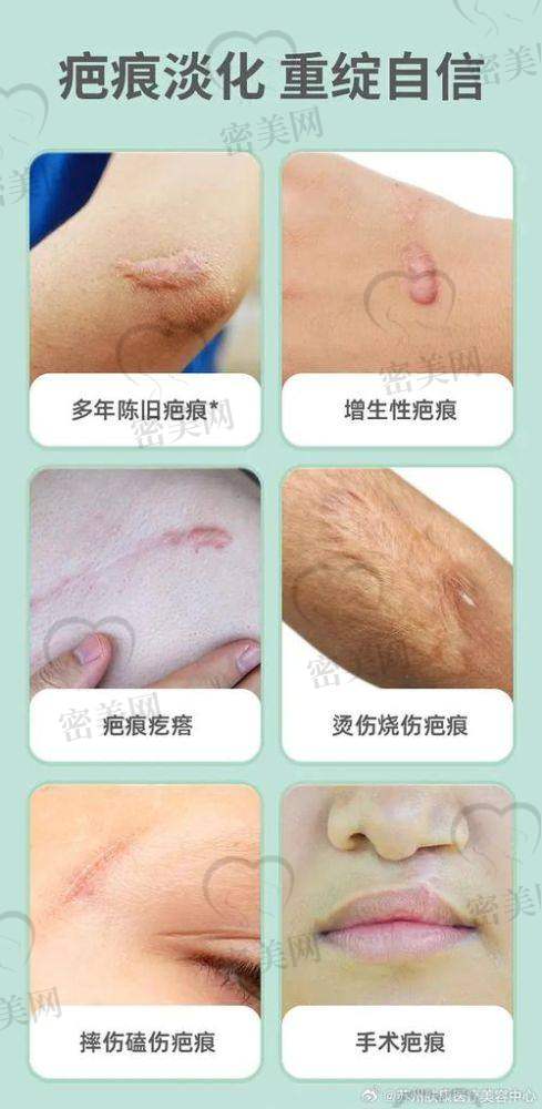 上海艺星整形医院：从疤痕到纹身艺术的完美蜕变
