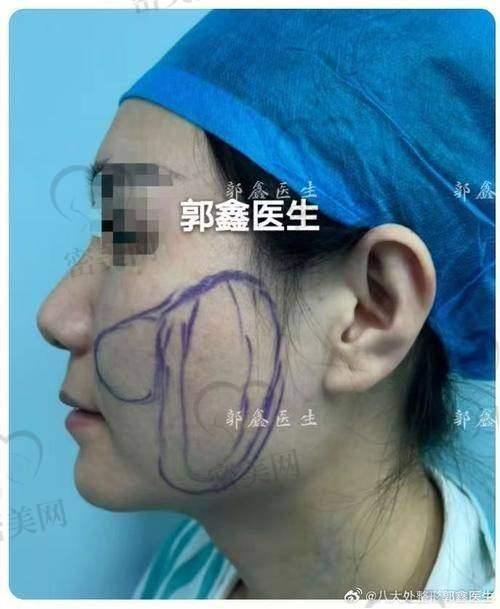 逆袭成功，从“发面馒头脸”到精致小V脸