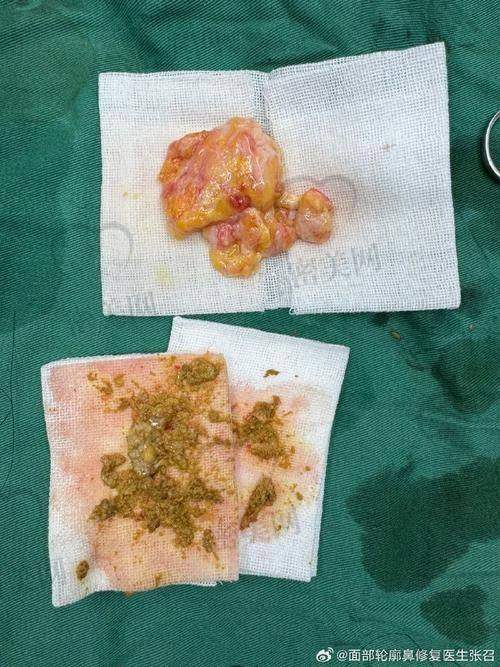 成都美莱医院：麻醉技术领跑，术中舒适感TOP