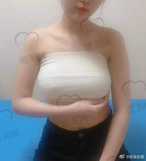 北京圣嘉新医疗美容医院自体脂肪丰胸技术揭秘