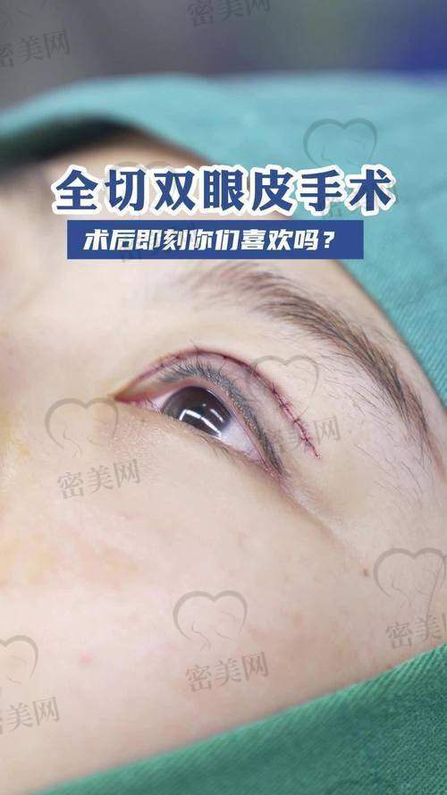 真实反馈告诉你：选择孙玮奇做双眼皮，一点都不踩坑