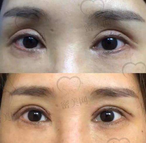 眼部整形中的个性化设计理念：孙玮奇医生的主打差异