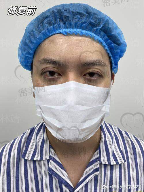 刘志刚医生：修复失败双眼皮的高发“救场大神”