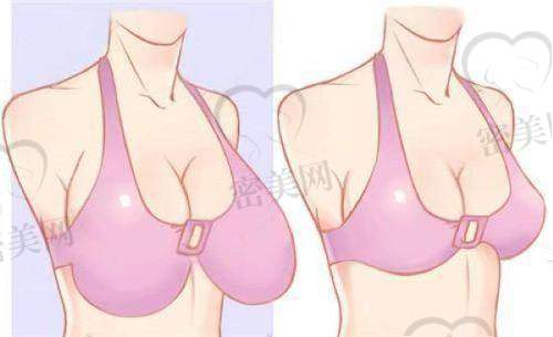 重庆当代整形外科医院：巨乳缩小手术的优质之选