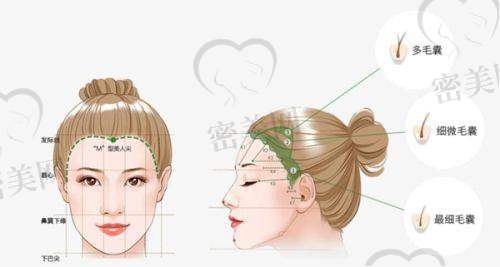 柳州睿冠植发中 心：男士鬓角+美人尖种植推荐