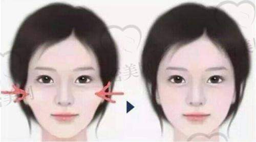价格贵不贵?下颌角、颧骨项目公开透明,按成效值定价