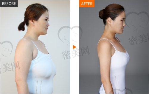 重庆当代整形外科医院安可忍巨乳缩小手术：口碑评价超赞