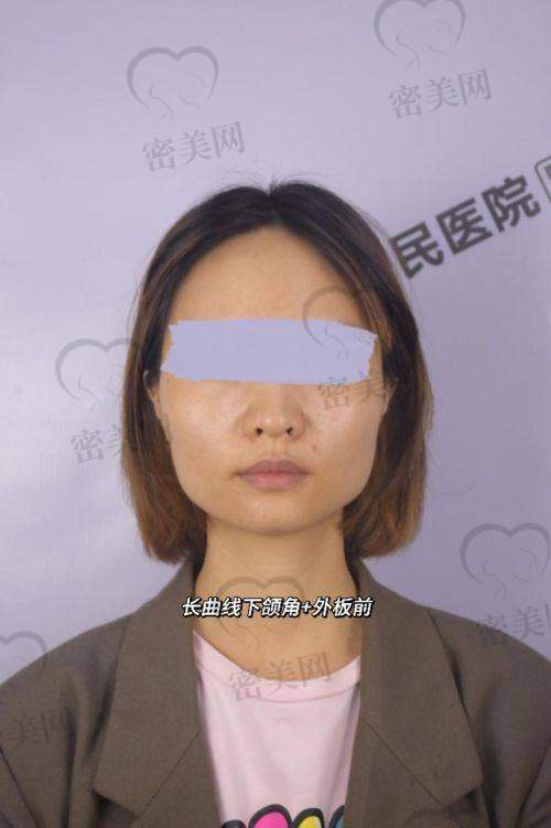 重庆松山医院王涛颧骨整形：价格香到离谱！