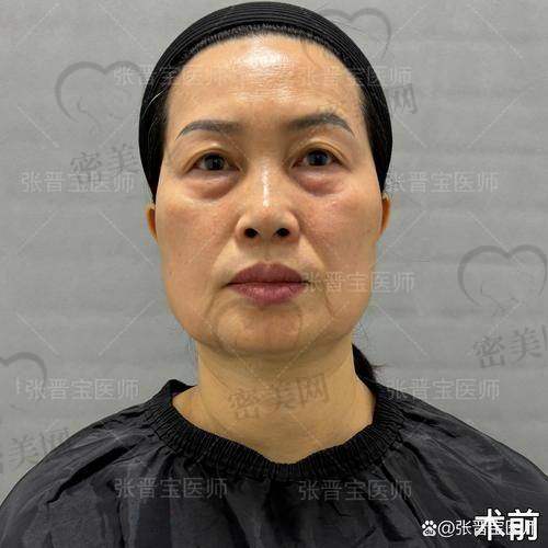 去泪沟的手术方法及费用