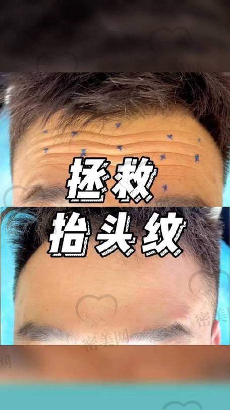 不同年龄段适合的整形项目与去抬头纹的关联