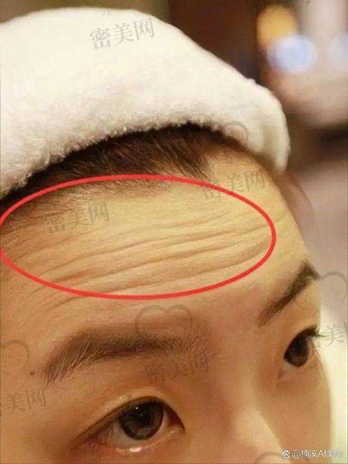 去抬头纹的价格因素