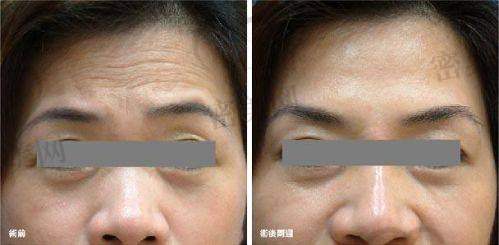 去除重度抬头纹的医美方法