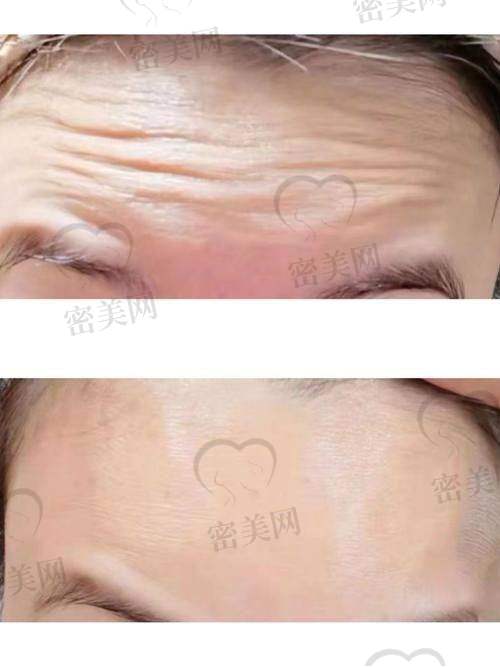 去除抬头纹的注意事项