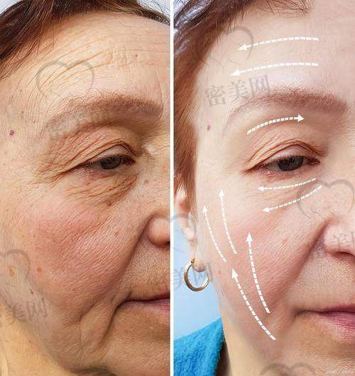 热门医美产品与去抬头纹