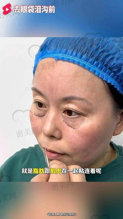 重庆华美紫馨刘天云 FCR 眼袋眶隔释放术：真人实例见证奇迹